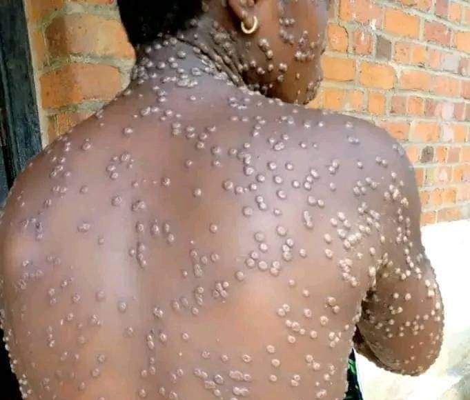 Mpox alert in Malawi: Authorities confirm two suspected cases in Blantyre